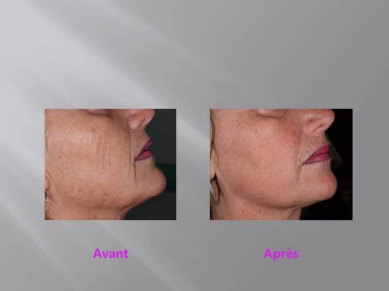 Les fils PDO : une alternative à l'acide hyaluronique