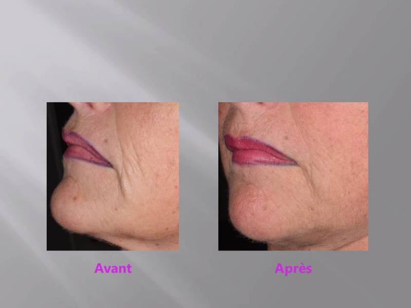 Les fils PDO : une alternative à l'acide hyaluronique