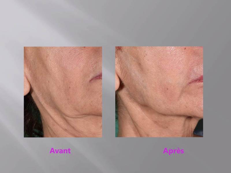 Les fils PDO : une alternative à l'acide hyaluronique