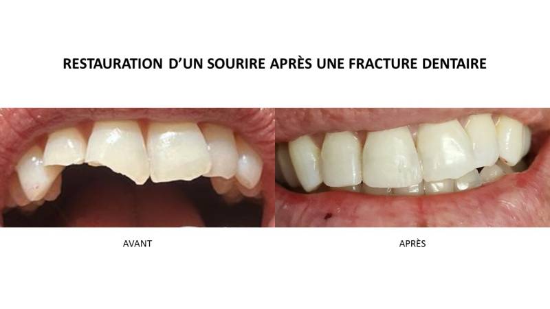 fracture dentaire, composite antérieur, Dr Pignard, Auriol, 13390