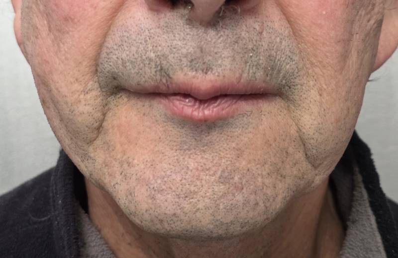 Lifting sans chirurgie, après fils tenseurs, Dr Pignard, Auriol