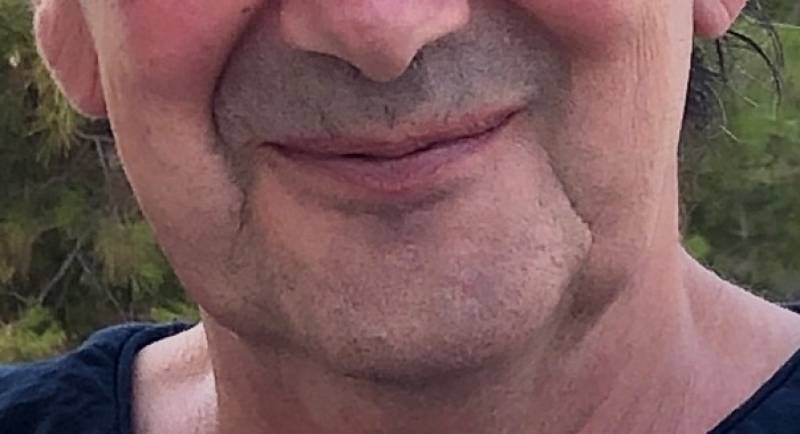 Lifting sans chirurgie, avant fils tenseurs, Dr Pignard, Auriol