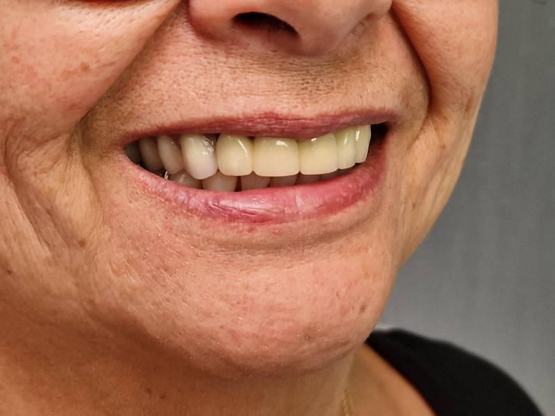 Sourire appareil en place, Dr Pignard, Auriol 13390