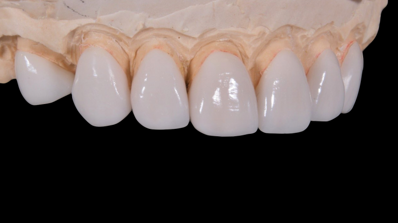 Facettes dentaires Dr Pignard Auriol