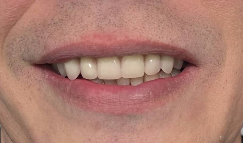 Esthétique du sourire, Dr Nicolas Pignard, Auriol 13390