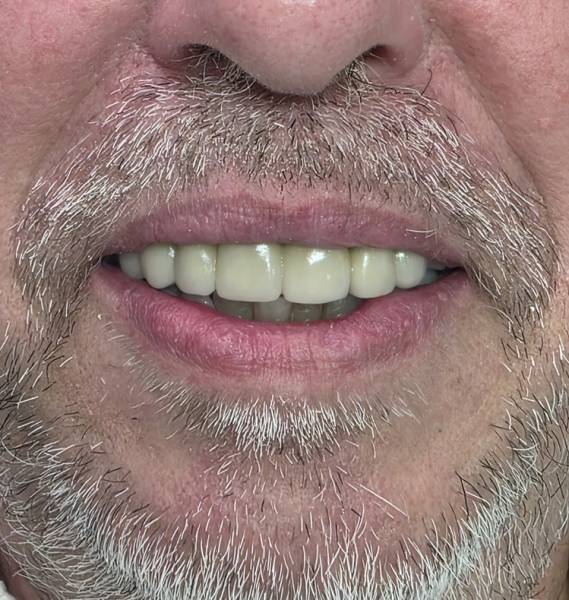Esthétique du sourire, Dr Nicolas Pignard, Auriol 13390