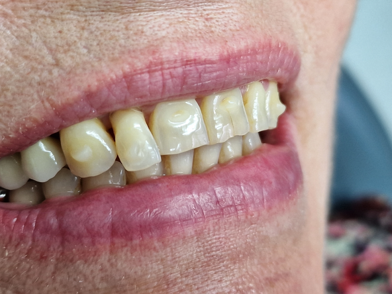 Orthodontie par gouttières, taquets, Dr Pignard, Auriol 13390